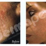 dermapen user experiences and honest review real results from microneedling treatments