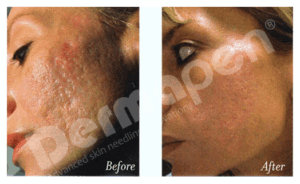 Dermapen User Experiences and Honest Review: Real Results from Microneedling Treatments