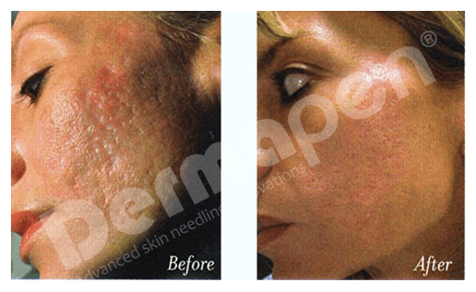 Dermapen User Experiences and Honest Review: Real Results from Microneedling Treatments